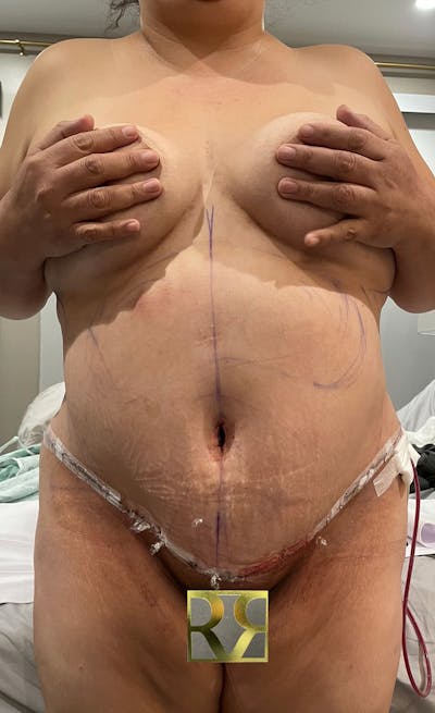 Plus Size Tummy Tuck: Day After Surgery Before & After Gallery - Patient 117399 - Image 2