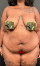 Plus Size Tummy Tuck: Early Recovery Before & After Gallery - Patient 144540679 - Image 1