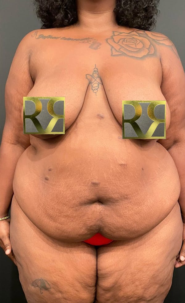 Plus Size Tummy Tuck: Early Recovery Before & After Gallery - Patient 144540679 - Image 1