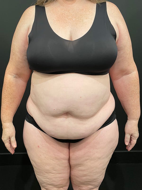 Plus Size Tummy Tuck® Before & After Gallery - Patient 147063059 - Image 1
