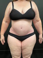 Plus Size Tummy Tuck® Before & After Gallery - Patient 147063059 - Image 2