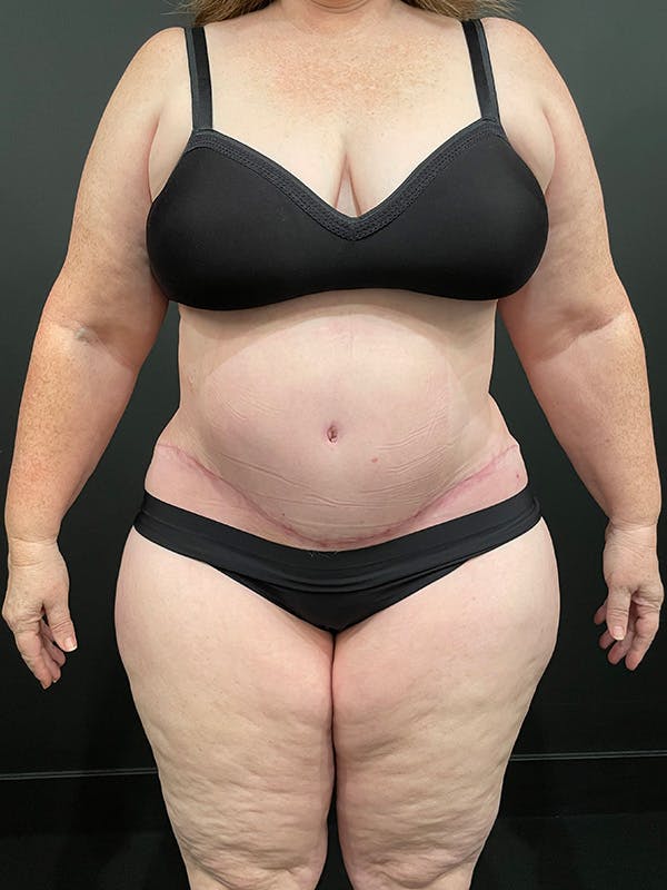 Plus Size Tummy Tuck® Before & After Gallery - Patient 147063059 - Image 2