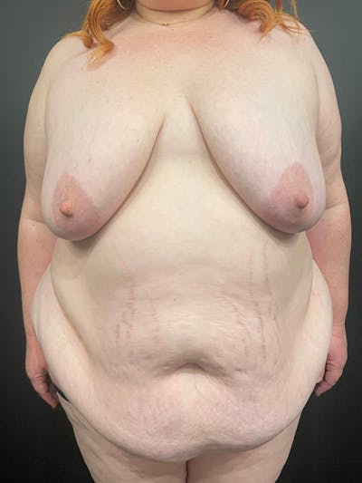 Plus Size Tummy Tuck® Before & After Gallery - Patient 148448207 - Image 1