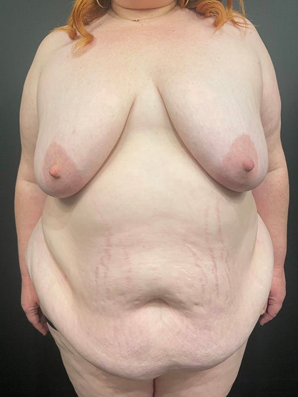 Plus Size Tummy Tuck® Before & After Gallery - Patient 148448207 - Image 1