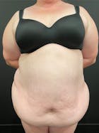 Plus Size Tummy Tuck® Before & After Gallery - Patient 148448206 - Image 1