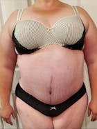 Plus Size Tummy Tuck® Before & After Gallery - Patient 148448206 - Image 2