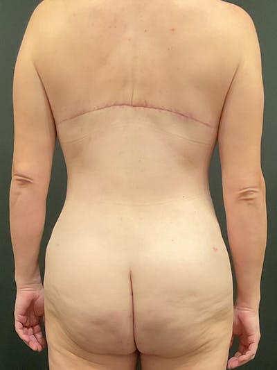 Tummy Tuck Before & After Gallery - Patient 149097333 - Image 8
