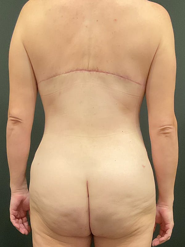 Tummy Tuck Before & After Gallery - Patient 149097333 - Image 8