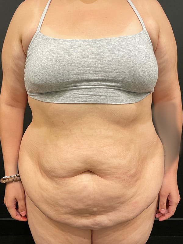 Tummy Tuck Before & After Gallery - Patient 149097332 - Image 1