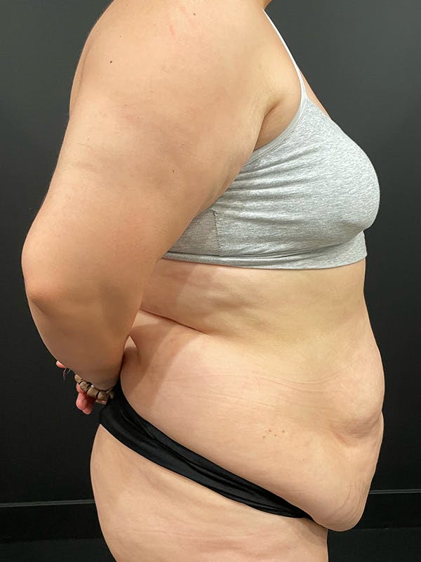 Tummy Tuck Before & After Gallery - Patient 149097332 - Image 3