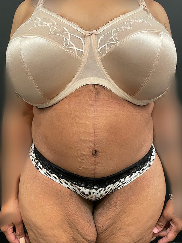 Plus Size Tummy Tuck® Before & After Gallery - Patient 152396847 - Image 2