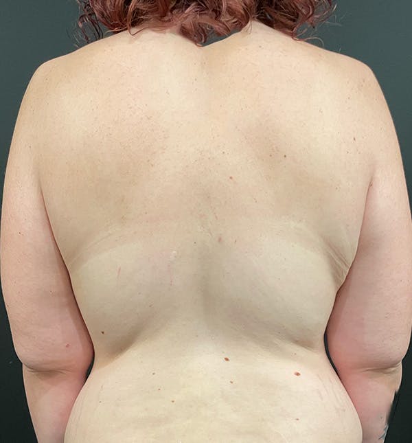 Bra Line Back Lift™ Before & After Gallery - Patient 152396859 - Image 1