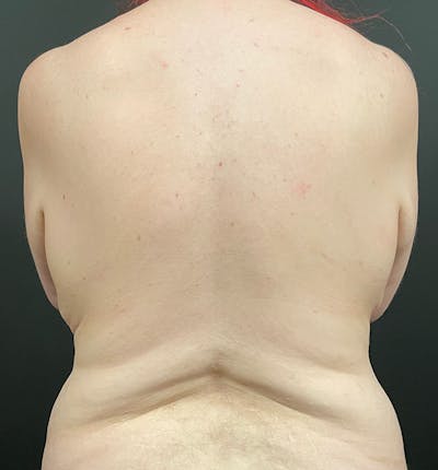 Back and Bra-Line Liposuction Photos - Plastic surgeon doctor