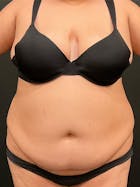 Plus Size Tummy Tuck® Before & After Gallery - Patient 152529541 - Image 1