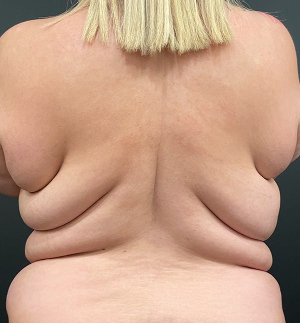 Bra Line Back Lift™ Before & After Gallery - Patient 152529542 - Image 1