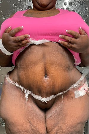 Plus Size Tummy Tuck