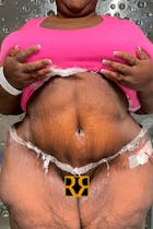 Plus Size Tummy Tuck® Before & After Gallery - Patient 160205445 - Image 2