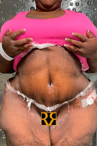 Plus Size Tummy Tuck: Week After Surgery Before & After Gallery - Patient 103555 - Image 2