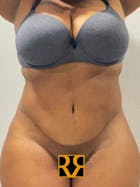 Plus Size Tummy Tuck® Before & After Gallery - Patient 152529539 - Image 2