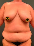 Plus Size Tummy Tuck® Before & After Gallery - Patient 152529540 - Image 1