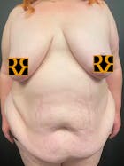 Plus Size Tummy Tuck® Before & After Gallery - Patient 152396846 - Image 1