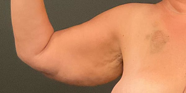 Arm Lift Before & After Gallery - Patient 172701535 - Image 5