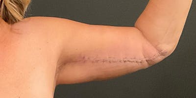 Arm Lift Before & After Gallery - Patient 172701535 - Image 4