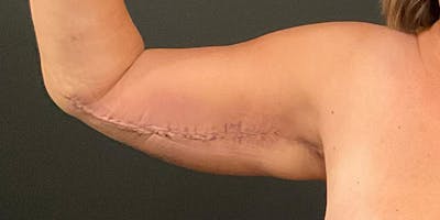 Arm Lift Before & After Gallery - Patient 172701535 - Image 6