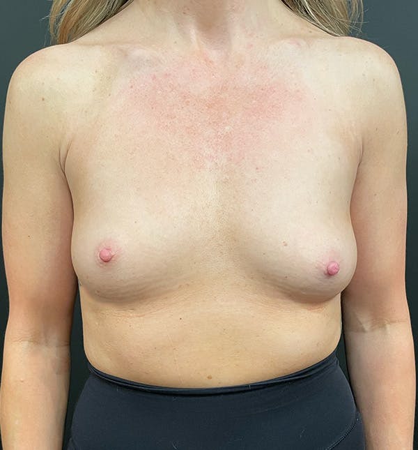 Breast Augmentation Before & After Gallery - Patient 172702284 - Image 3