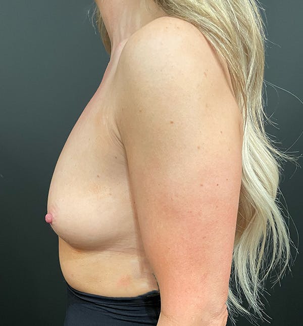 Breast Augmentation Before & After Gallery - Patient 172702284 - Image 5
