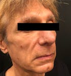 Facelift Before & After Gallery - Patient 172702285 - Image 1