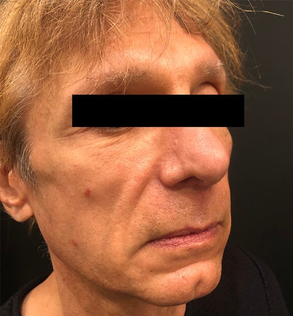 Facelift Before & After Gallery - Patient 172702285 - Image 1