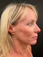 Facelift Before & After Gallery - Patient 172702286 - Image 1