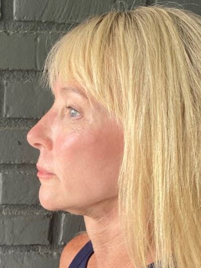 Facelift Before & After Gallery - Patient 172702286 - Image 6