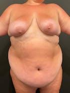 Plus Size Tummy Tuck® Before & After Gallery - Patient 172702291 - Image 1