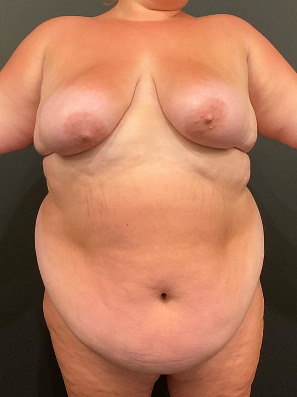 Plus Size Tummy Tuck® Before & After Gallery - Patient 172702291 - Image 1