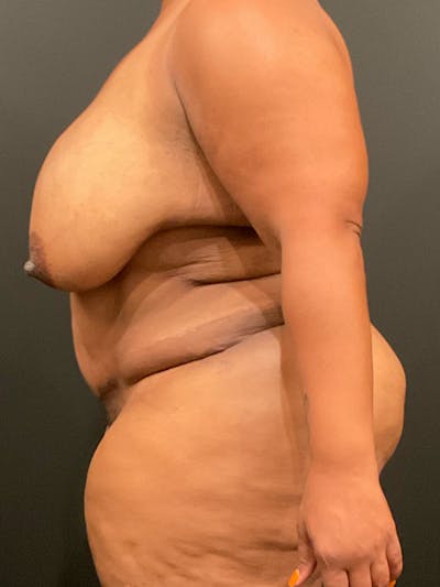 Plus Size Tummy Tuck® Before & After Gallery - Patient 172702292 - Image 6