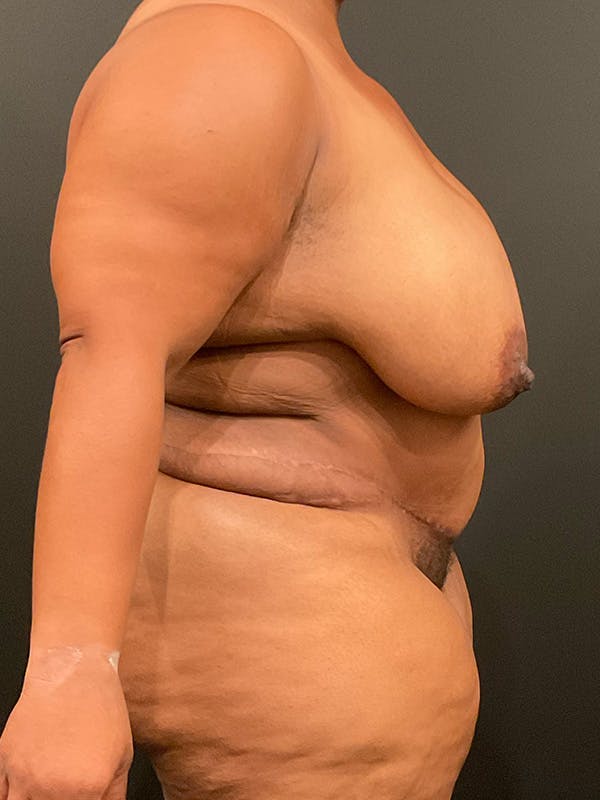 Plus Size Tummy Tuck® Before & After Gallery - Patient 172702292 - Image 4