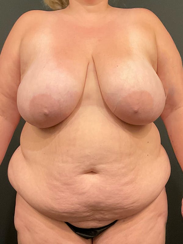 Plus Size Tummy Tuck® Before & After Gallery - Patient 172702288 - Image 1