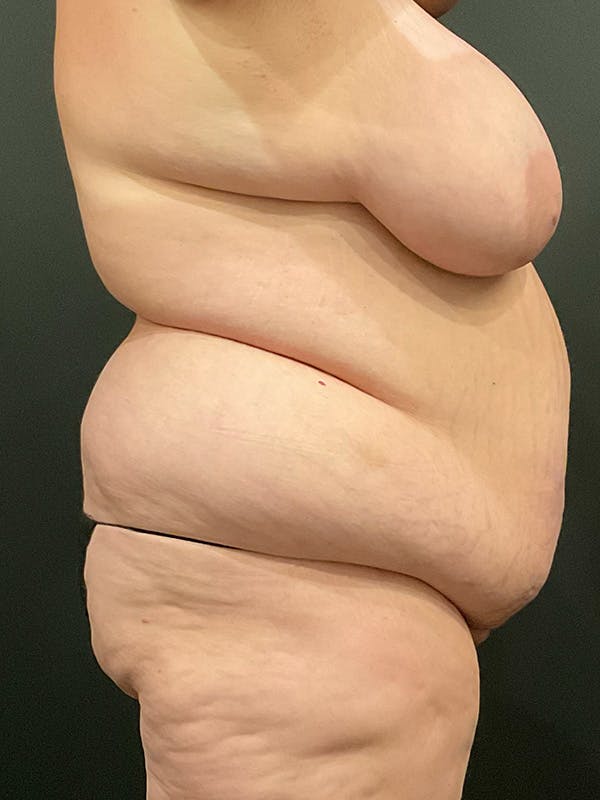 Plus Size Tummy Tuck® Before & After Gallery - Patient 172702288 - Image 3
