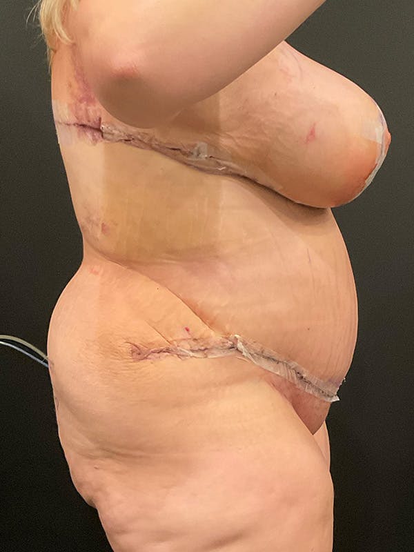 Plus Size Tummy Tuck® Before & After Gallery - Patient 172702288 - Image 4