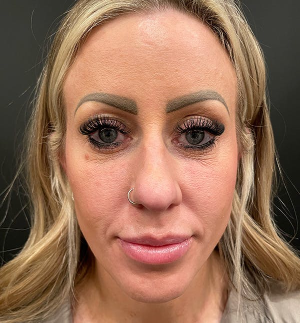 Rhinoplasty Before & After Gallery - Patient 172702293 - Image 3