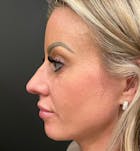 Rhinoplasty Before & After Gallery - Patient 172702293 - Image 1