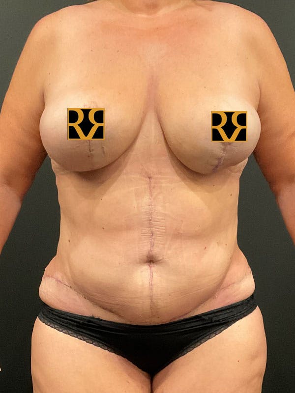 Tummy Tuck Before & After Gallery - Patient 248902 - Image 2