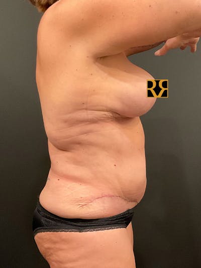 Tummy Tuck Before & After Gallery - Patient 248902 - Image 6
