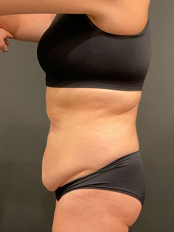 Tummy Tuck Before & After Gallery - Patient 313322 - Image 5