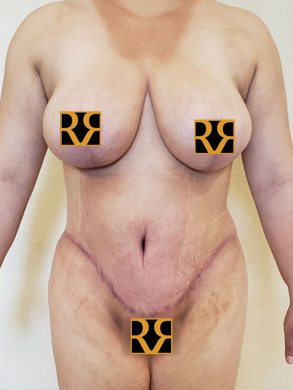 Tummy Tuck Before & After Gallery - Patient 221192 - Image 2