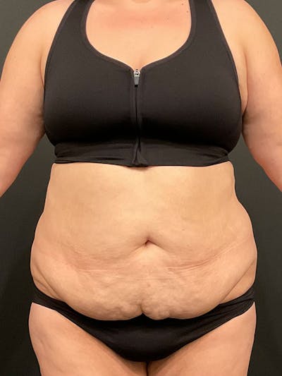 Tummy Tuck Before & After Gallery - Patient 137580 - Image 1