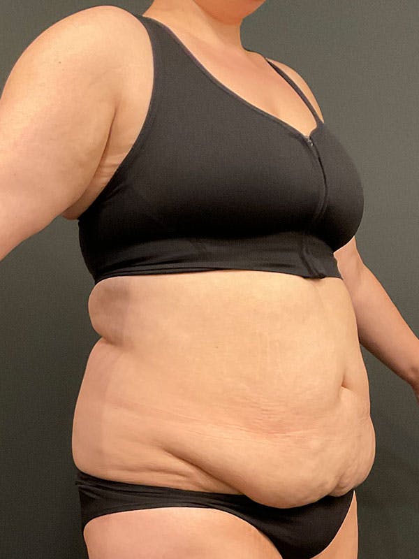 Tummy Tuck Before & After Gallery - Patient 137580 - Image 3