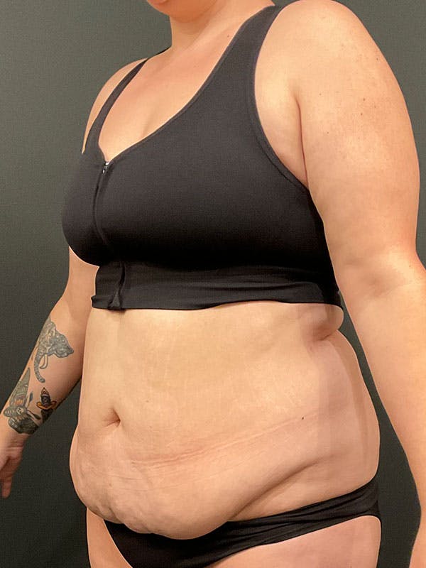 Tummy Tuck Before & After Gallery - Patient 137580 - Image 5